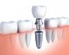 Cấy Ghép Implant Những Điều Bạn Cần Biết